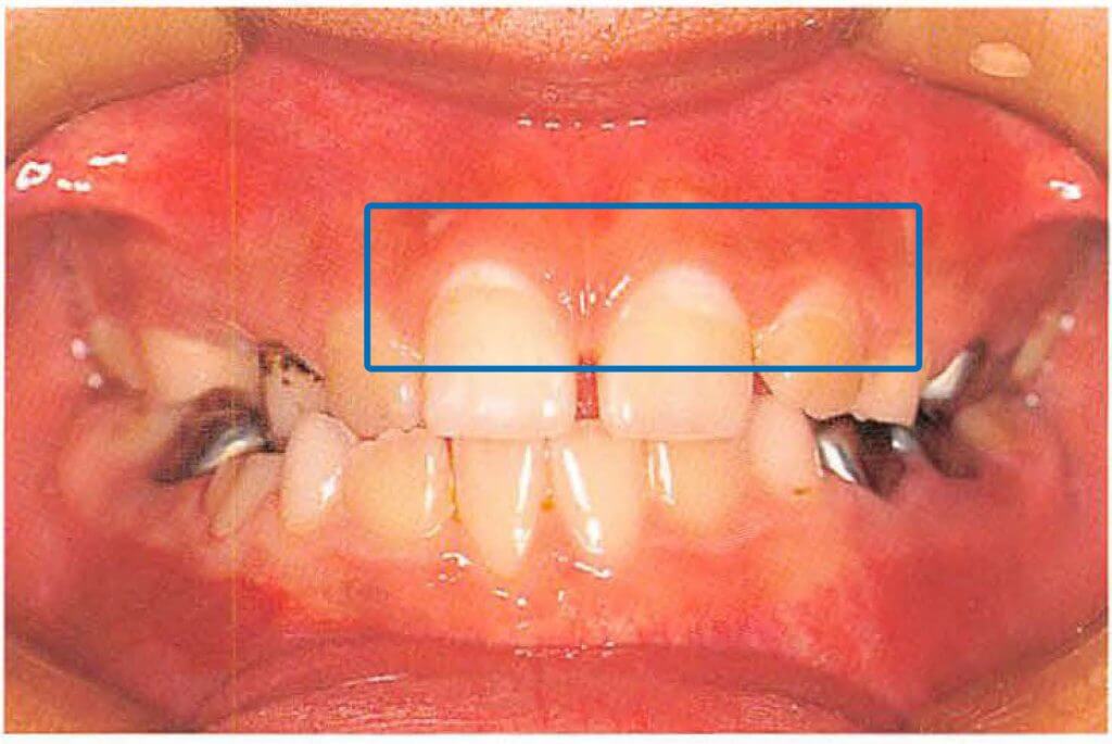 乳歯の白い斑点や白濁は初期虫歯かも 原因と予防法を解説 乳歯防衛軍