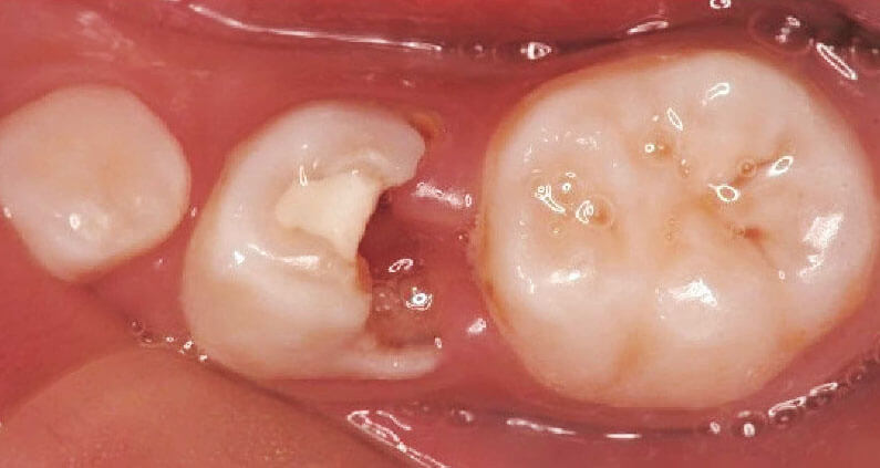 子供の虫歯治療で乳歯の神経を抜くことに 永久歯はどうなる 乳歯防衛軍